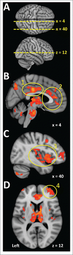 Figure 3. Widely distributed brain regions have been implicated in thermoregulation in humans. The panels in this figure include brain activations associated with heating-related sweating as an exemplar of the regions that most consistently show responses during thermal challenges. A. The dotted yellow lines indicate the positions of slices that appear in the remaining panels. Distances in millimeters lateral to the midline of sagittal slices are indicated as ‘x’ values. The axial slice is 12  mm superior of the anterior commissure (z = 12). B. The cingulate cortex frequently activates in studies involving thermal challenge. These activations have been recorded in the posterior cingulate cortex (1) and the anterior cingulate cortex (2). C. The insula cortex (3) has been ascribed a role in temperature sensation and also activates in association with thermoregulatory sudomotor responses. D. The prefrontal cortex (4) is another region that activates during thermal stimulation. (Data used to create this figure has been presented elsewhere using different analyses and renderingsCitation51).