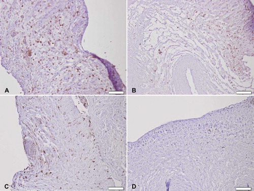 Figure 6. Immunohistochemical CD3+ T-cell staining seven days after implantation of (A) trypsin, (B) osmotic, (C) trypsin-osmotic, (D) detergent-osmotic treated matrices. Trypsin (A) and trypsin-osmotisc matrices (C) show a strong inflammatory infiltration. Osmotic leaflets (B) show a milder inflammatory response. Only a few CD3 + T-cells are present in detergent-osmotic matrices (D). Scale bar 100μm.
