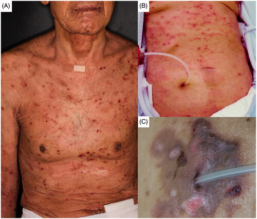 Figure 1. Skin lesions of Case 1 (A), Case 2 (B), and Case 3 (C).