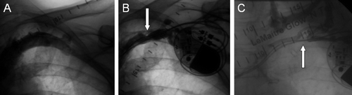 Figure 1.  Venographic images prior to implantation of a dual chamber pacemaker (A), and 6 months (B) and 25 months (C) postoperatively on a 57-year-old male patient. A stenosis (arrow) of the subclavian vein was seen in the 6-month study (B), and complete occlusion of the same vessel with collateral venous flow after 2 years (C).