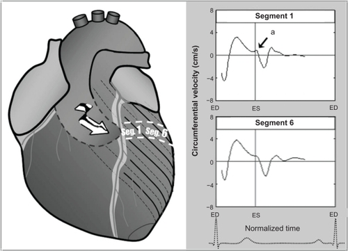 Figure 6 The brief notch of clockwise rotation (a) in the anterior ventricular segments could be explained by potential propagation of the reflected wave on these segments, given the orientation of the aortic arch. The graphs represent average values for all volunteers. Positive values show clockwise rotation, while negative values reflect counterclockwise motion.