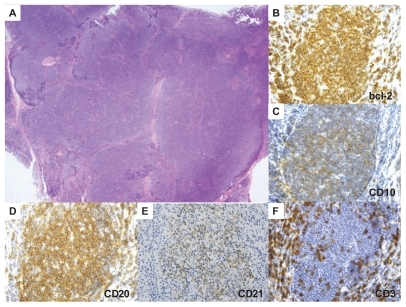 Figure 2 Histologic and immunohistochemical analyses. A) Hematoxylin and eosin image. There is a diffuse proliferation of atypical cells with occasional follicular pattern. B–F) Immunohistochemical images. The tumor cells expressed bcl-2 (B) and CD10 stains only a small proportion of the cells in the nodule (C), CD20 (D), and CD21 (E). A follicular pattern can be seen with CD3+ T cells (F). A) magnification × 2; B–F), magnification × 40.
