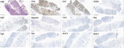 Figure 2 H&E, typical image of pathology. Immunohistochemical staining images of pan cytokeratin (PCK) (+), cytokeratin 7 (CK7) (+), cytokeratin 5/6 (CK5/6) (+) and Ki67 (60%).