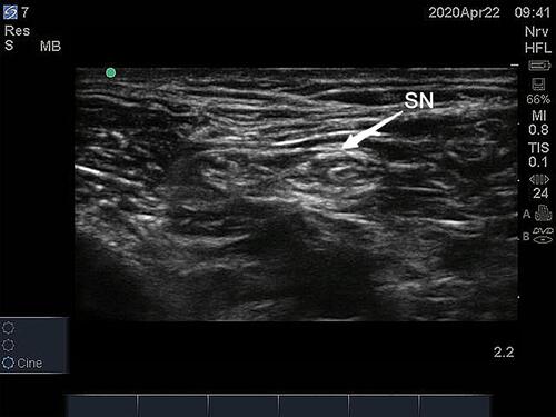 Figure 1 Sciatic nerve image under ultrasound scan.SN, sciatic nerve.