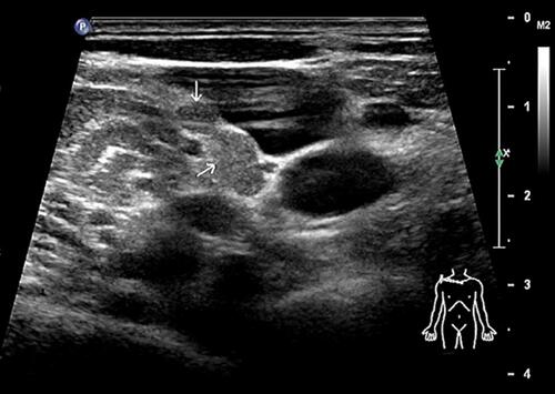 Figure 4 An enlarged lymph node that can be touched on the surface of the body is proven to be structurally abnormal by color ultrasound and is eventually used for pathological biopsy.