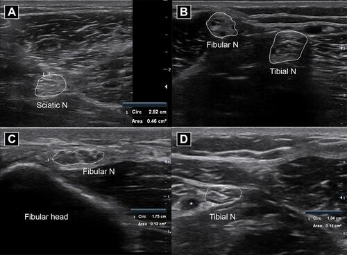 Figure 5 Cross-sectional view of the normal sciatic nerve in the distal thigh (A), fibular and tibial nerves in the popliteal fossa (B), fibular nerve at the fibular head (C) and tibial nerve just above the ankle, * denote the ulnar artery (D).