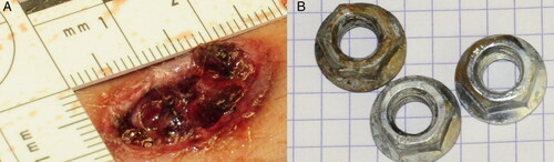 Figure 2. Photograph showing an irregularly-shaped skin wound (A) caused by shrapnel-like projectiles (nuts) (B) found near the shallow orifice.