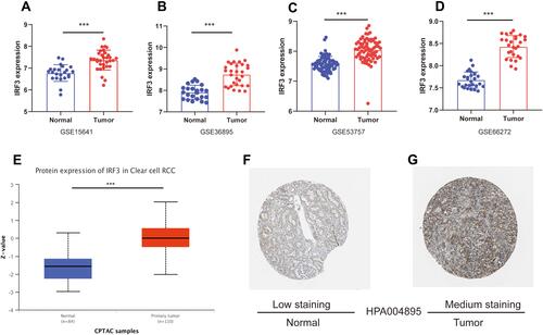 Figure 6 Validation of IRF3 expression in ccRCC. (A–D) IRF3 was highly expressed in ccRCC samples compared to in noncancerous samples in the GSE15641, GSE36895, GSE53757, and GSE66272 datasets. (G) Protein expression data from the UALCAN database revealed that IRF3 protein was also significantly higher in ccRCC tissues than in adjacent normal tissues. (F–G) The immunohistochemical staining is “Low” in normal renal sample; while the immunohistochemical staining is “medium” in ccRCC sample.