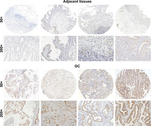 Figure 2 Representative images of GALNT6 IHC staining in gastric tissues.