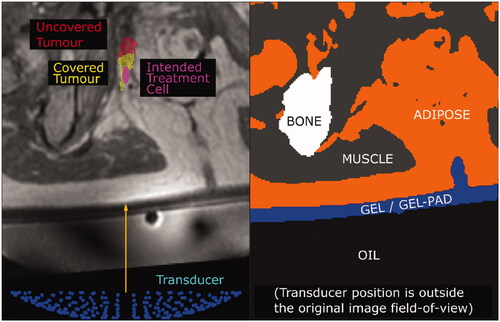 Figure 2. The simulation grid (left) extracted from the original patient MR image is segmented into different tissues and materials (right). Physical properties (i.e., density, sound-speed, attenuation coefficient, thermal conductivity, specific heat capacity) were assigned to each voxel based on their tissue/material. For exposure points in which the transducer (blue, left) is situated outside the original patient MR image field-of-view, as in the case in this example (patient P3, halfway exposure point), all voxels outside the original patient MR image field-of-view were assigned the properties of the Sonalleve® oil (black region, right).