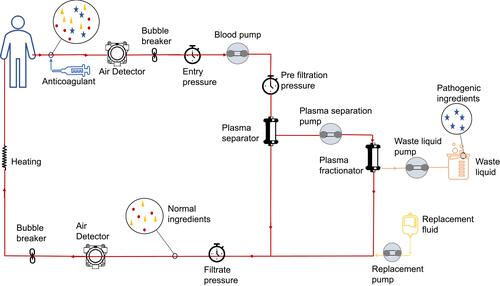 Figure 2 The principle of double filtration plasmapheresis (DFPP). The blood passed through the plasma separator and then passed through the plasma fractionator, and the filtered components were also returned to the human body after being combined with the replacement solution.