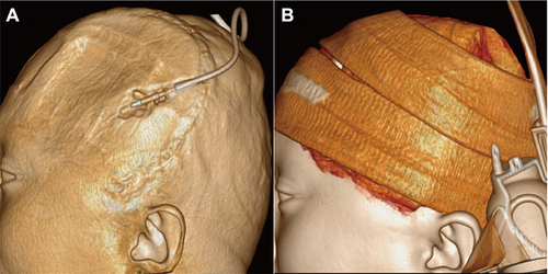 Figure 2 Location of subcutaneous drainage tube and method of compression in skull defect area. (A) Location of subcutaneous drainage tube. (B) A sport headband is used to pressurize the skull defect area.