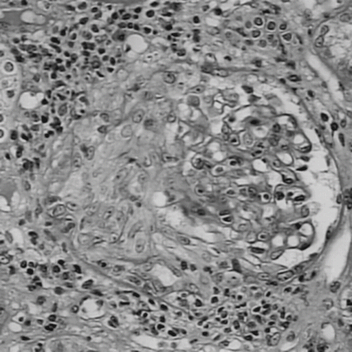Figure 1. PAS staining demonstrated circumferential and cellular crescent formation with interstitial nephritis.