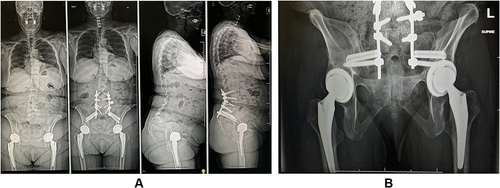 Figure 1 Sample case: Sacroiliac joint fusion using porous, 3D printed titanium, triangular-shaped implants placed posteriorly across the sacral-alar-iliac trajectory. (A) AP and lateral views of the spine. (B) Ferguson view of the pelvis.