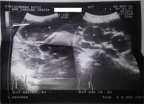 Figure 1 The masses as seen on an ultrasound of the abdomen.