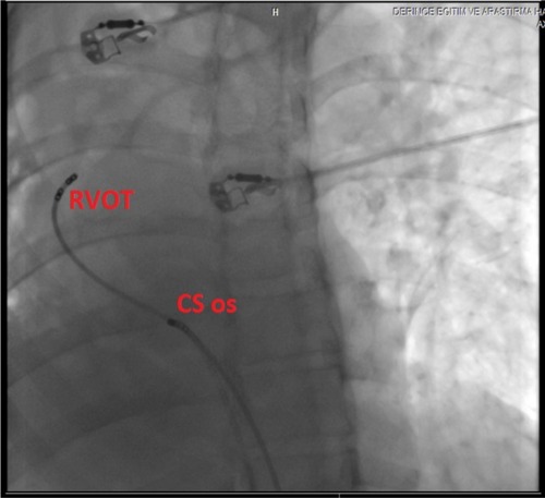 Figure 7 Fluoroscopic image with a modified anteroposterior projection showing an ablation catheter at the region of the coronary sinus ostium (CS os) and a quadripolar diagnostic catheter on the right ventricular outflow tract (RVOT).
