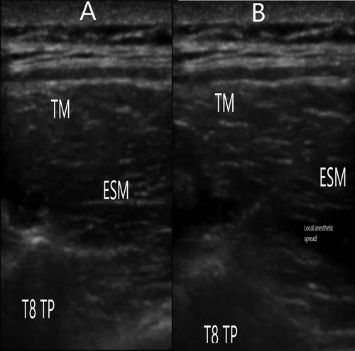 Figure 1. Ultrasound guided erector spinae plane block after needle contact to T8 transverse process in image (A) and after injection of local anaesthetic showing its spread in the erector spinae plane in image (B). TM: Trapezius muscle, ESM: Erector spinae muscle, T8 TP: Transverse process of T8.