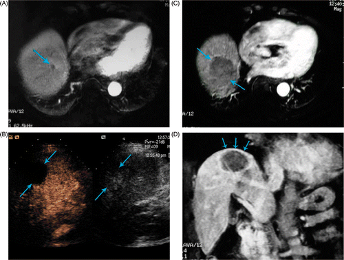 Figure 2. Liver cancer abutting dome of the diaphragm of a 65-year-old man treated with MWA. (A) Before ablation, tumour (arrowhead) is seen in MRI scans. (B) One day after ablation, the ablated zone (arrowhead) was evaluated by contrast enhanced sonography. (C) One month after ablation, the ablation zone (arrowhead) has no arterial enhancing in MRI scans. (D) Six months after ablation, MRI coronal plane scans show the diaphragm (arrowhead) has not been destroyed and the ablation zone has no local tumour progression.