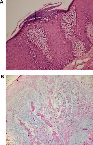 Figure 2 Pathological section showing hyperkeratosis with parakeratosis and Munro micro-abscess (arrow) formation in the epidermis (Hematoxylin and Eosin, ×400) (A). Alcian blue stain showing excessive mucin deposition in the dermis (Alcian blue, ×200) (B).