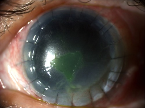 Figure 5 Corneal ulcer after 2 weeks of study treatment (V2).