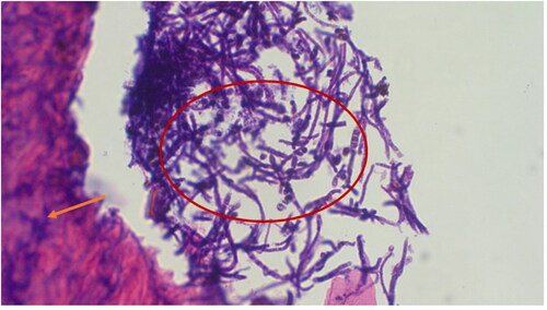 Figure 4. Giraffe skin disease section by HE staining showing a complex of fungal hyphae (circle) chronic inflammation and extravasation of red blood cells (magnification of 40 times) [arrows].