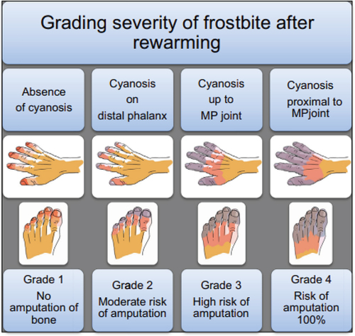 Figure 2. Grading severity of frostbite and bone amputation risk after rewarming [Citation41].