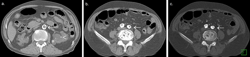 Figure 5 Pre- (a and b) and post-contrast (c) injection reveal the classic pattern of circumferential atherosclerosis with the so-called ring-shaped sign of calcific plaques (arrows) extending from the infrarenal abdominal aorta (a) to the common iliac arteries (b). Additionally, a portion of both kidneys (a) shows the classic imaging stigmata of nephropathy chronification, including intra-renal arteries atherosclerosis (arrowhead), polycystic changes (asterisk) denoting recurrent dialysis, loss of volume, and atrophied kidneys. Post-contrast CTA (c) shows patent iliac vessels despite extensive atherosclerosis (arrow).