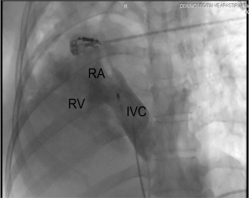Figure 4 Fluoroscopic view in the 15° anteroposterior projection after contrast injection.