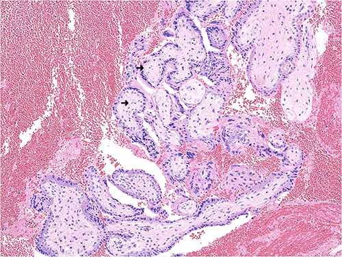 Figure 2 Light microscopy findings (×200). Hematoxylin-eosin–stained specimen shows chorionic villi without enlargement and decidua with hemorrhagic changes.
