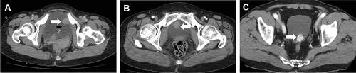 Figure 1 The CT scans of the three cases. (A) Case 1, CT scans of the tumor on the left wall of bladder. (B) Case 2, CT scans of the tumor on the bladder anterior wall. (C) Case 3, CT scans of the tumor on the posterior wall of bladder.