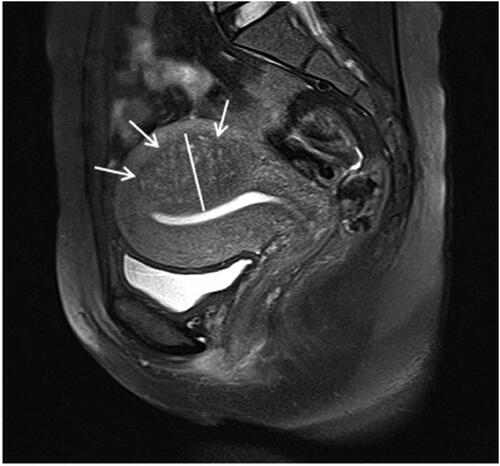 Figure 2. A 36-year-old patient with adenomyosis. The posterior wall of the uterus was locally thickened, and the muscle layer signal was reduced (white arrows). The thickness of the junctional zone is defined as the maximum thickness of the junctional zone in the sagittal position of T2WI (white line).