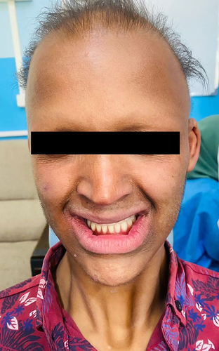 Figure 6 After prosthetic rehabilitation, final look.