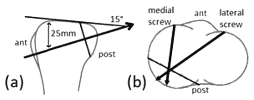 Figure 1. The different techniques of reduction: a) endobutton; b) screws.