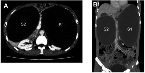 Figure 1 CT image of the left (S1) and right (S2) gastric duplication cysts. (A) Transveral plane; (B) coronal plane.