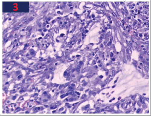 Figure 3. The biopsy of stomach shows cellular infiltration with poorly differentiated adenocarcinoma.