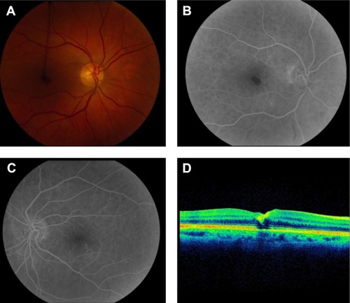 Figure 2 Fundus photographs and arteriovenous phase of fluorescein angiogram in case 2.