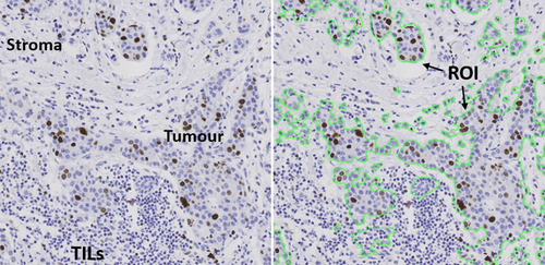 Figure 2 Tumor region of interest (ROI).