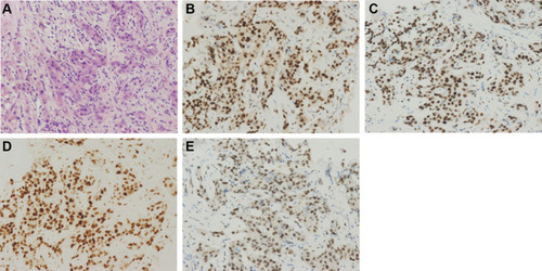 Figure 1 Intrahepatic cholangiocarcinoma staining. (A) Hematoxylin and eosin staining. Immunohistochemical analysis of samples positive for (B) MLH1, (C) MSH2, (D) MSH6, and (E) PMS2. Magnification: × 200.