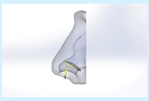 Figure 1. An example of a nasal filter and the placement in the nose.