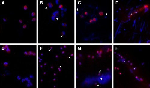 Figure 5 Analysis of NETosis and EETosis by immunofluorescence.Notes: DAPI-positive (blue) material associated to the eosinophil MBP (A–D in red) or to the neutrophil elastase (E–H in red). Preserved eosinophils in healthy smokers (A) and disrupted eosinophils in COPD B group (B and C), appearing free or associated to extracellular traps (arrowheads) are shown. Neutrophils are negative for MBP (arrows in B and C). Released-MBP immunolabeling can be seen associated to extracellular DNA in a COPD C group patient (* in D). Elastase labels neutrophils in the cytoplasm in healthy smokers (E) while NETotic neutrophils in COPD B group (F) start to colocalize with DNA (arrows). Panels G and H show extensive NETs (◊) in COPD D group patients associated with neutrophils (arrows) and disrupted neutrophils associating their DNA to extracellular traps (* in H). Original magnification: 400×.Abbreviations: COPD, chronic obstructive pulmonary disease; DAPI, 4′, 6-diamidino-2-phenylindole; EETosis, eosinophil extracellular trap cell death; MBP, major basic protein; NETosis, neutrophil extracellular trap cell death.