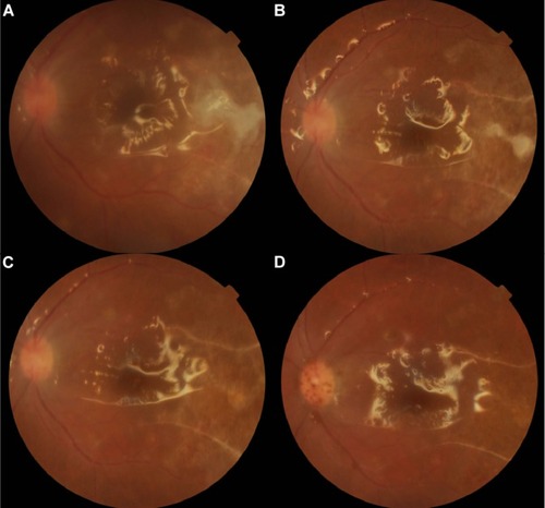 Figure 3 Gradual resolution of the retinitis and occlusive vasculitis with treatment.