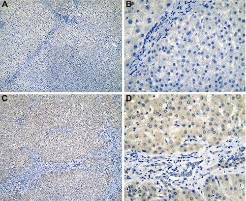 Figure 3 The IHC of para-HCC tissues with cirrhosis.