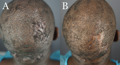 Figure 7 Patient 4 with FD plaque involving the right parietal prominence area before surgical excision and AKN lesions in the nape zone. (A) and four months after complete excision of the FD lesion and healing by second-intention, aided by guarded high-tension sutures and a minor skin graft (B).