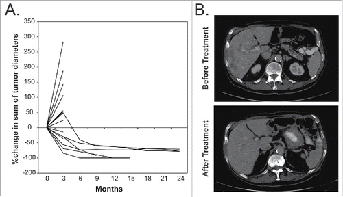 Figure 3. Illustration of Clinical Outcome. (A) The percentage change in the sum of the index tumor diameters for all patients that remained in the study long enough to have follow-up imaging. (B) A pre-treatment image of liver metastases for one patient and a follow-up image of the same area approximately 12 mo later showing resolution of the liver metastases. The remaining hypodense lesion is thought to represent a hepatic cyst.