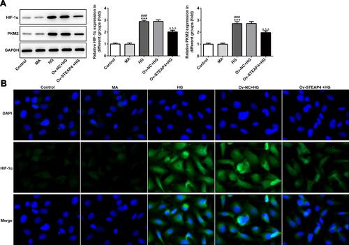 Figure 8 Overexpression of STEAP4 inhibited the activity of HIF-1α/PKM2 signal pathway. (A) The expression of PKM2, HIF-1α was detected by Western blot. (B) The expression of HIF-1α was detected by immunofluorescence. n=3, ***p<0.001 vs Control; ###p<0.001 vs MA; ΔΔΔp<0.001 vs Ov-NC+HG.Abbreviations: Ov-NC, overexpression-NC; Ov-STEAP4, overexpression-STEAP4; HG, high glucose.