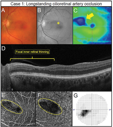 Figure 2. Longstanding cilioretinal artery occlusion in the left eye of a 51-year-old male (Case 1). (A) No evidence of a retinal embolus with colour fundus photography. (B) Red-free fundus photography highlights a papillomacular retinal nerve fibre layer defect (asterisk). (C) Horizontal OCT imaging demonstrates focal thinning of the retina (blue hue) corresponding to the affected area (arrow) located primarily superior-nasally to the fovea. (D) Nasal focal inner retinal thinning and disorganisation (yellow bracket) on OCT line scan through the superior macula. (E) 6 × 6OCT-A superficial slab (defined as inner limiting membrane to posterior inner plexiform layer) and (F) 6 × 6OCT-A deep slab (defined as posterior inner plexiform layer to posterior outer plexiform layer). Both superficial and deep capillary plexuses display reduced capillary perfusion (yellow oval). (G) Corresponding inferotemporal defect of the left eye with the 10–2 visual field test grid (grey scale is shown).
