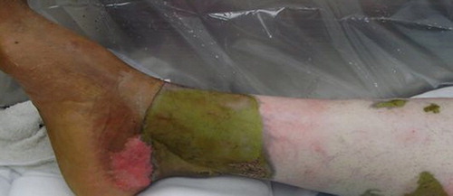 Fig. 1. Lower extremity of a 52-year-old Hispanic male who sustained chemical burns after exposure to a heated chromic acid mixture. The photograph was taken 1 h after exposure. The white discoloration represents a full thickness circumferential burn. The green discoloration represents staining of the epidermis by the chemical mixture.