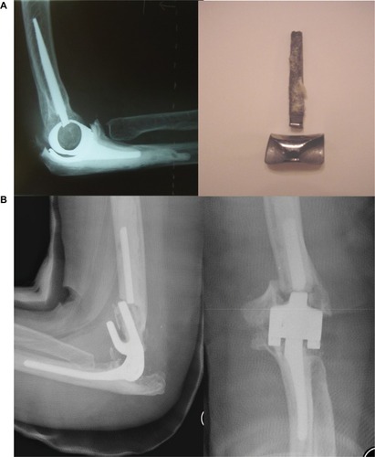 Figure 5 Complications of TER: mechanical failure.