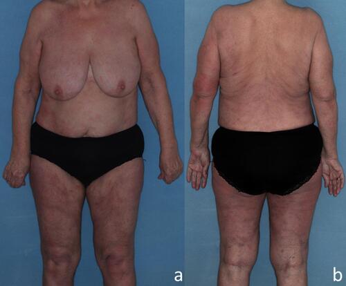 Figure 3 Clinical presentation of the patient 21 days after the initial photographs were taken. Dramatic improvement of the lesions 2 weeks after the first infusion of infliximab and 3-week treatment with acitretin (A and B).