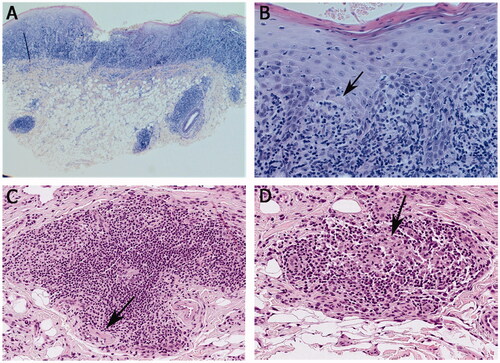 Figure 2. Histopathological findings from labial mucosal biopsies. (A, B) Hyperparakeratotic stratified squamous epithelium with saw-toothed rete ridges in some areas, basal cell degeneration, apoptotic basal keratinocytes (arrow in B) and inflammatory cell exocytosis. A dense band-like lymphocytic infiltration in the lamina propria and patchy inflammatory cell infiltrates in the submucosa. (C) An aggregate of monocytic inflammatory cells consisting mainly of lymphocytes, visible also perineurally (marked by the arrow). (D) Possible histiocytes visible in the infiltrate (indicated by the arrow). Haematoxylin and eosin stain, original magnification × 25 (A), × 200 (B), × 400 (C), × 400 (D).